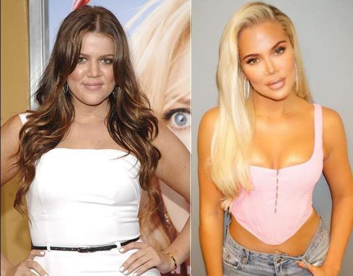  Khloé Kardashian admite por fin qué cirugía estética se hizo en la cara.