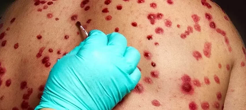  Posible caso de viruela del mono en el puerto de Veracruz y otro en Xalapa